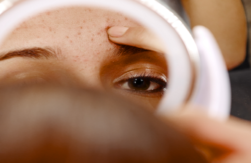 أمل جديد للمراهقين.. تطوير لقاحين لعلاج حب الشباب ومنعه