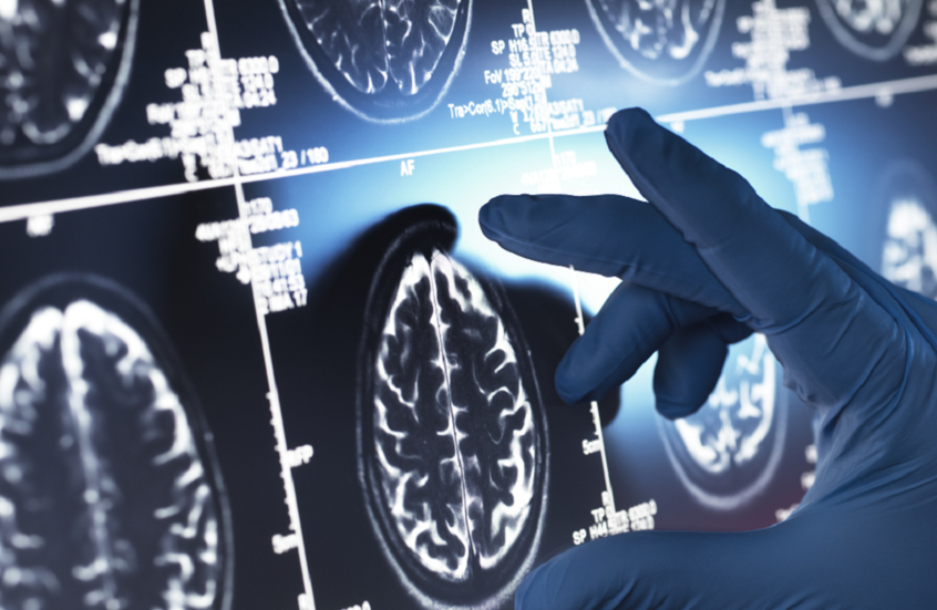 نوع شائع من التوابل يحقق نتائج واعدة في علاج ألزهايمر