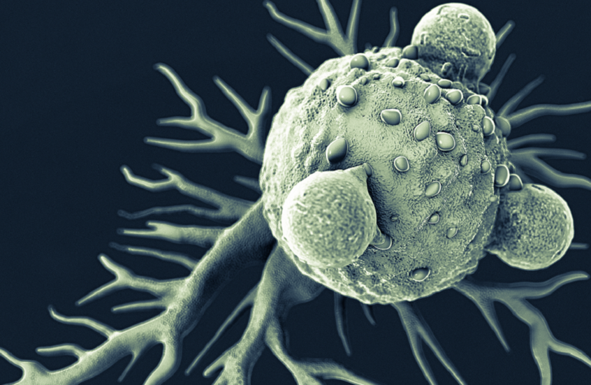 تحديد هدف علاجي جديد لسرطان البنكرياس العدواني