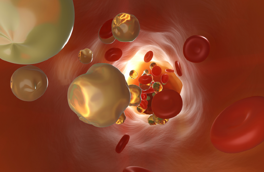 علامة صامتة لارتفاع الكوليسترول غالبا ما تُغفل في الشتاء