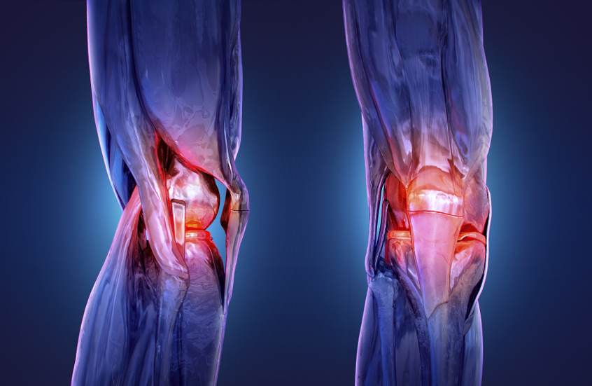 إشعاع منخفض الجرعة يفتح آفاقا لعلاج ألم الركبة المزمن