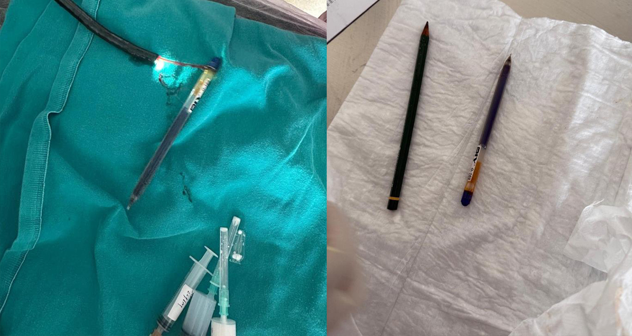 بسبب اضطراب نادر.. استخراج قلمين من معدة شابة تركية! (صور)