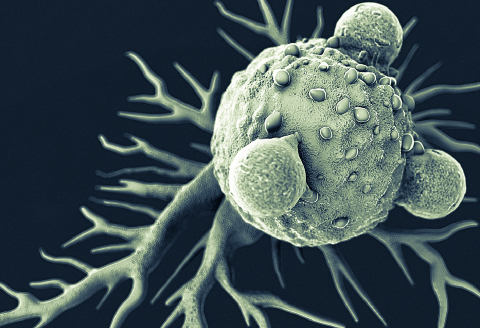 تحديد هدف علاجي جديد لسرطان البنكرياس العدواني