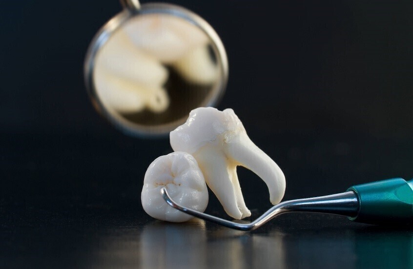 اكتشاف تأثير غير متوقع لقلع أضراس العقل