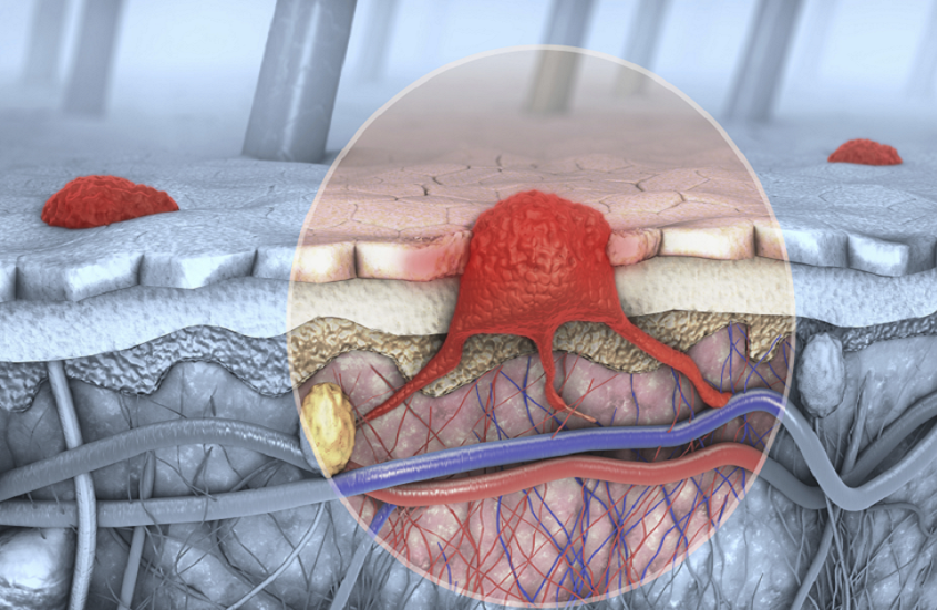 علماء روس يبتكرون هلاما لعلاج سرطان الجلد بفعالية مضاعفة