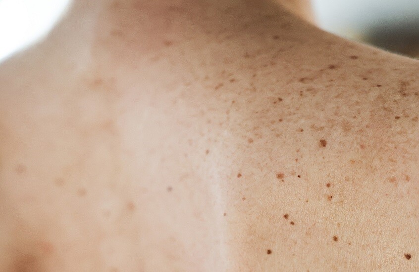 أسباب ظهور البقع الجلدية بعد الصيف وطرق علاجها