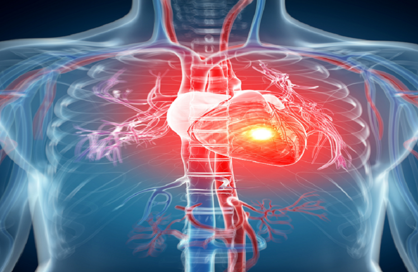 الفارق الأساسي بين النوبة القلبية وتوقف القلب المفاجئ