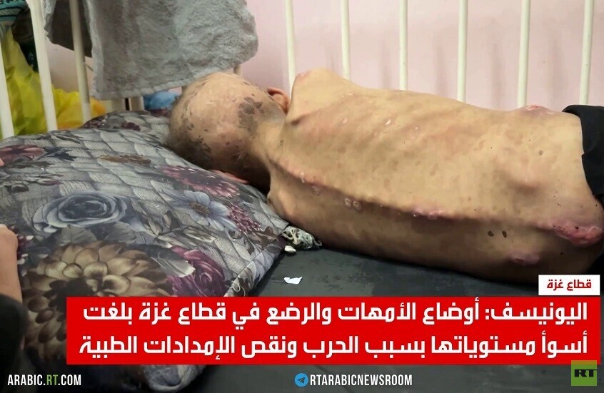 320 ألف طفل بغزة مهددون بسوء التغذية