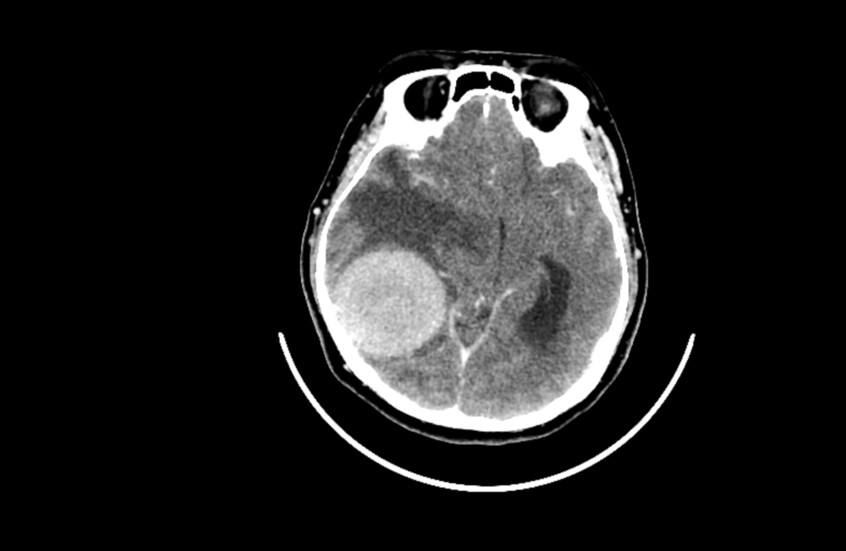 دراسة صادمة.. القلق والدوار يرتبطان بأورام الدماغ!