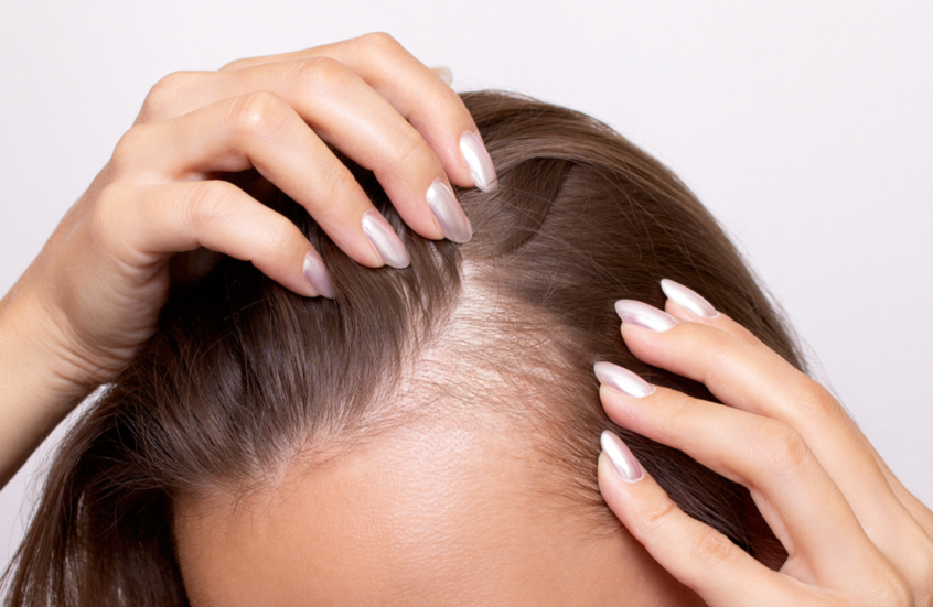 علاج فعّال لتساقط الشعر يحقق نتائج ملحوظة خلال شهرين فقط