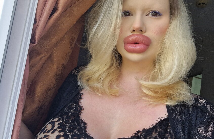 رسالة من صاحبة "أكبر شفاه في العالم"