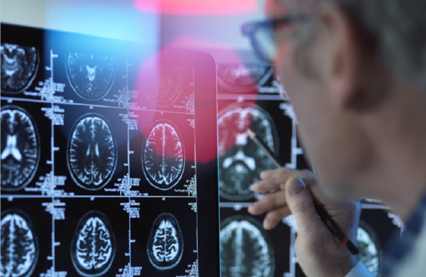 أسئلة بسيطة لمعرفة العلامات المبكرة لألزهايمر