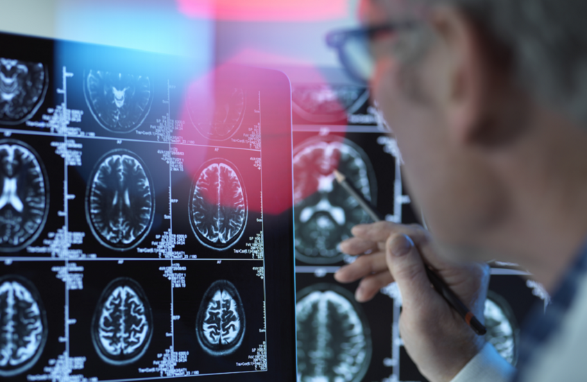 طريقة ثورية لرصد علامات ألزهايمر قبل بدايته