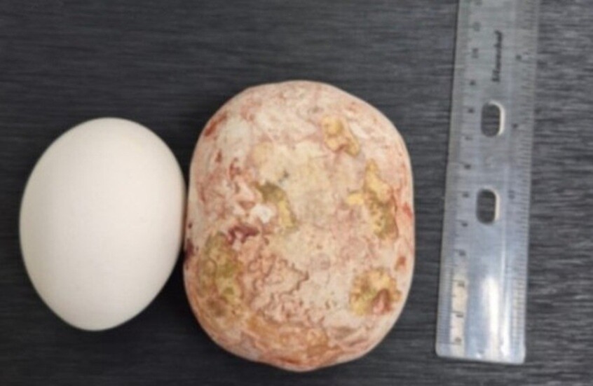 أطباء روس يستخرجون حصوة عملاقة تزن 1 كلغ من مثانة رجل