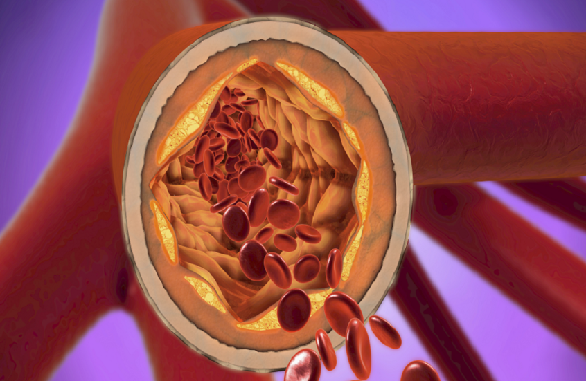 دواء جديد يخفض الكوليسترول الضار بنسبة قياسية