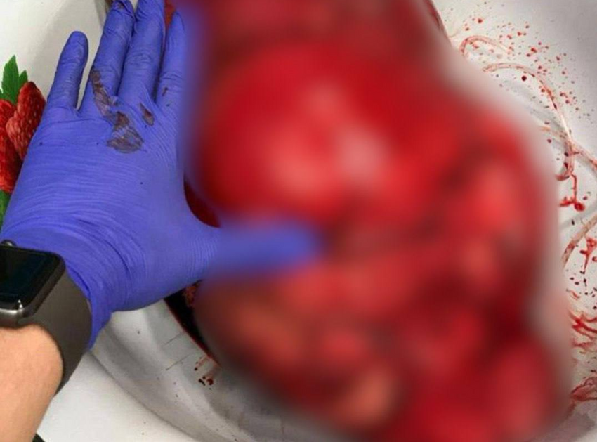 بعملية معقّدة.. أطباء روس ينجحون باستئصال ورم عملاق من جسم امرأة (فيديو)