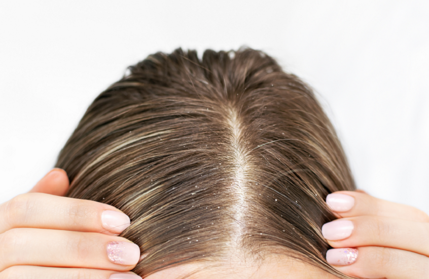 سبب خفي وراء قشرة الرأس المزعجة