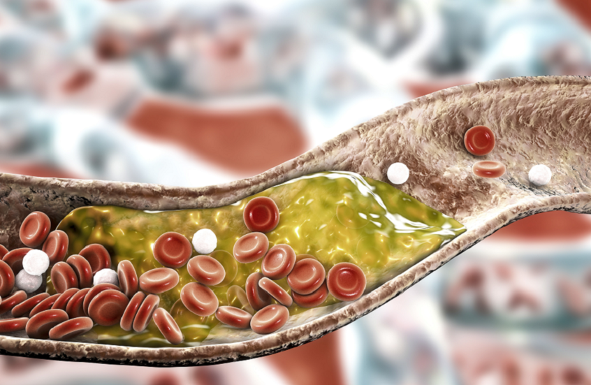 جرعة واحدة من دواء جديد قد تخفّض الكوليسترول مدى الحياة