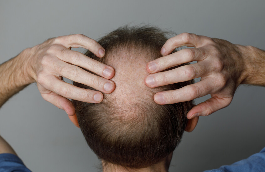 أمل جديد للرجال.. علاج ثوري يظهر نتائج مذهلة في استعادة الشعر المفقود