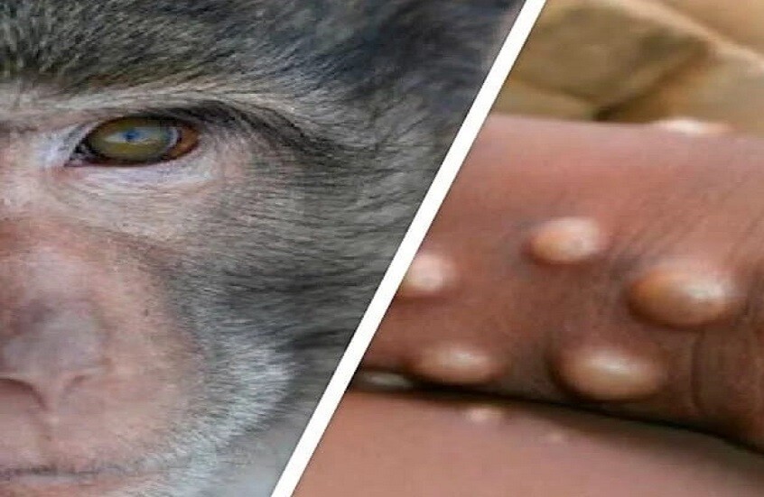 الذكاء الاصطناعي يكشف نقطة ضعف في لقاح جدري القرود