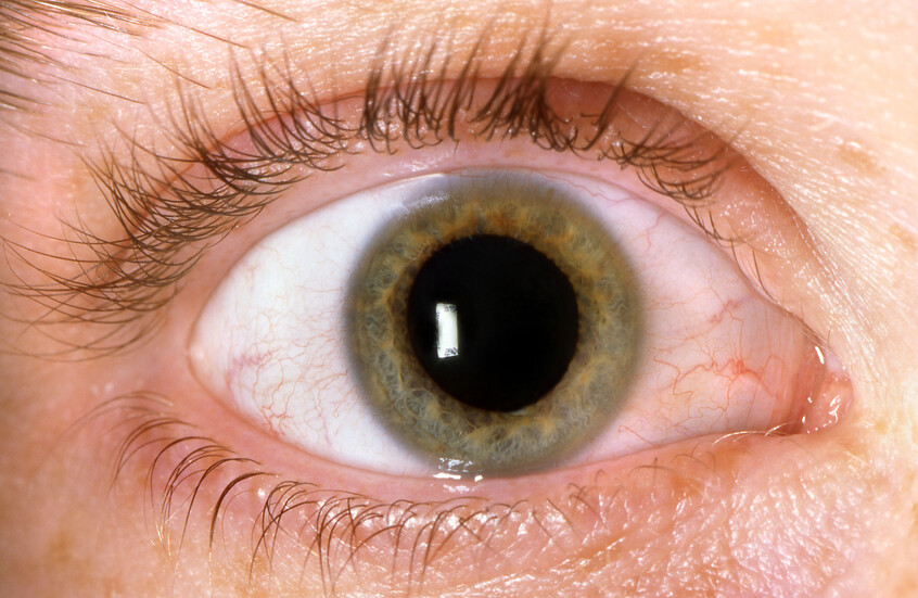 تأثير خفي لمرض السكري على صحة العين