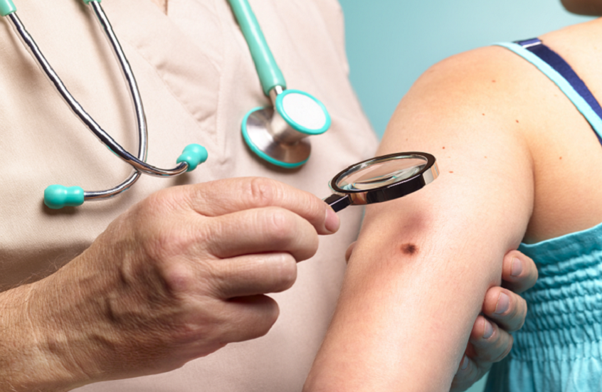 متى تصبح الشامة مقلقة؟.. علامات تستدعي الفحص الطبي فورا