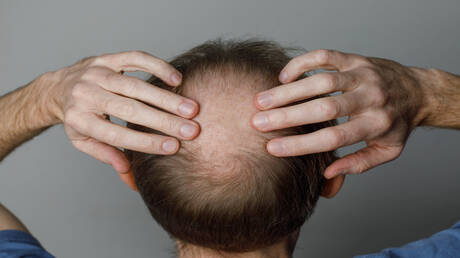 أمل جديد للرجال.. علاج ثوري يظهر نتائج مذهلة في استعادة الشعر المفقود 