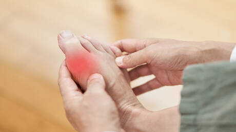 المصدر الحقيقي للنقرس 