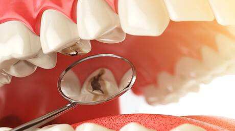 علماء روس يبتكرون هلاما يحمي الأسنان من التسوس 