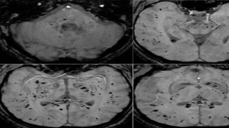تحليل بالرنين المغناطيسي يكشف تأثير كوفيد-19 المستمر على الدماغ