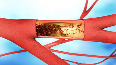 آلية جديدة تفسر كيف تتحول الدهون إلى لويحات داخل الشرايين 