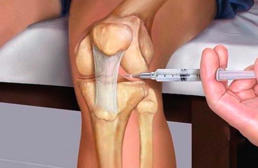 دواء مبتكر يجعل الغضروف "يبني نفسه من جديد"!