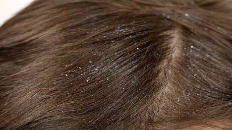 قشرة الرأس وأسبابها المتنوعة وكيفية التعامل معها بفعالية 