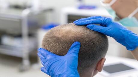 تفنيد معتقدات شائعة عن تساقط الشعر