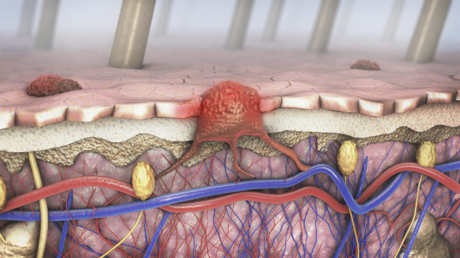 مكان غير متوقع قد يظهر فيه سرطان الجلد الميلانيني