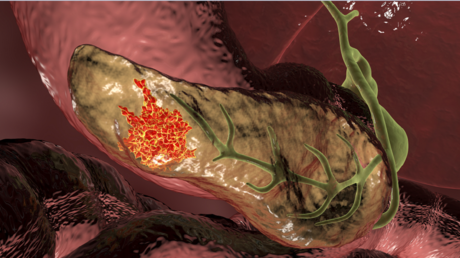 اختراق طبي.. تجربة جديدة تحقق "اختفاء دائما" لأورام البنكرياس - عاجل 