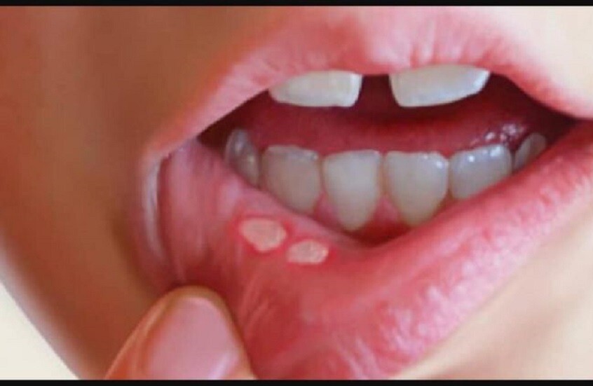 الأعراض المبكرة لسرطان الفم.. تعرف عليها قبل أن تتطور