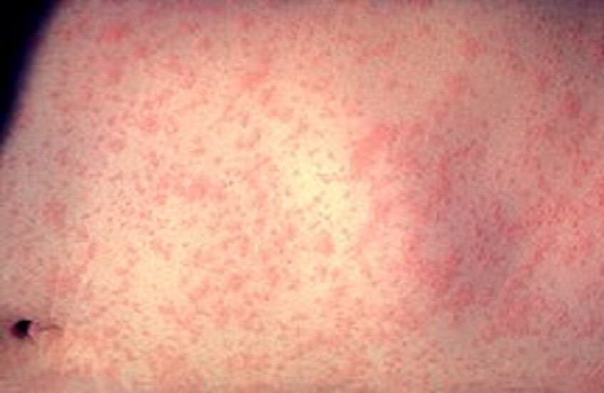 الأعراض الأولية للحصبة وموسم الإصابة بالمرض