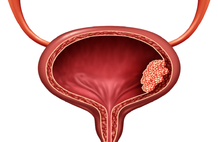 شركة Biocad الروسية تبدأ الدراسات السريرية لعقار جديد لسرطان المثانة