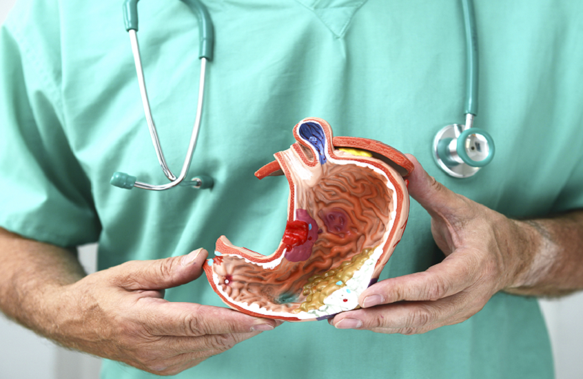 أخصائي أورام يوضح طبيعة سرطان المعدة