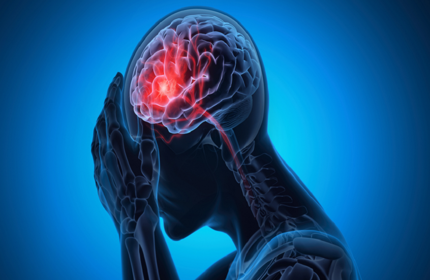 دراسة: مكان السكن يؤثر على فرص التعافي بعد السكتة الدماغية