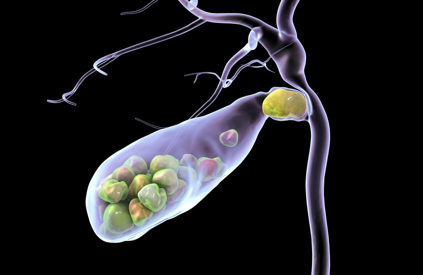 اكتشاف ارتباط عنصر شائع في نظامنا الغذائي بحصوات المرارة