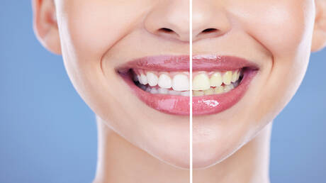 تقنية ثورية.. تطوير مسحوق يبيض الأسنان ويصلح المينا التالفة بشكل آمن وفعال