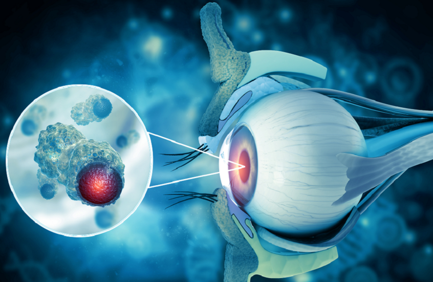 طريقة مبتكرة لعلاج أورام العين باستخدام مواد مأخوذة من السائل المنوي للخنازير