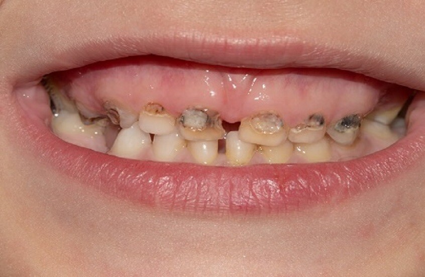 كيف يؤثر التدخين السلبي على صحة الفم لدى الأطفال؟.. الإجابة في نتائج دراسة سعودية