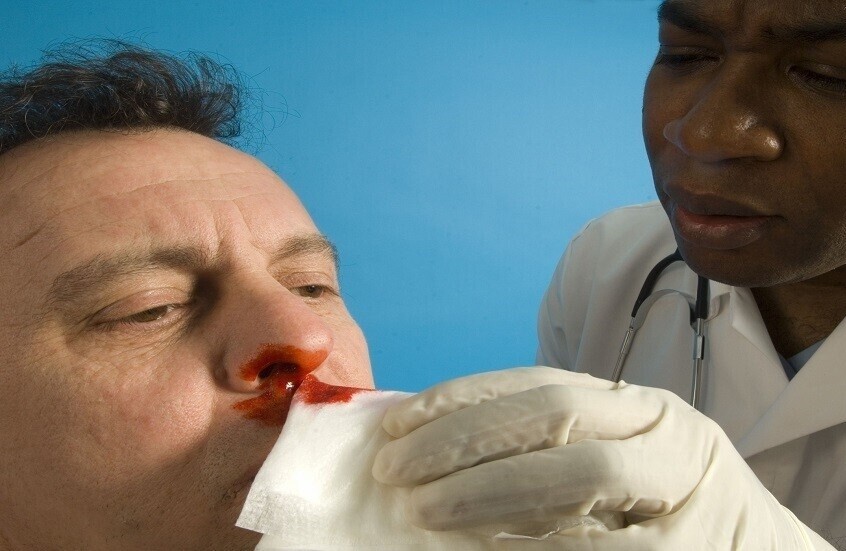 أسباب نزيف الأنف