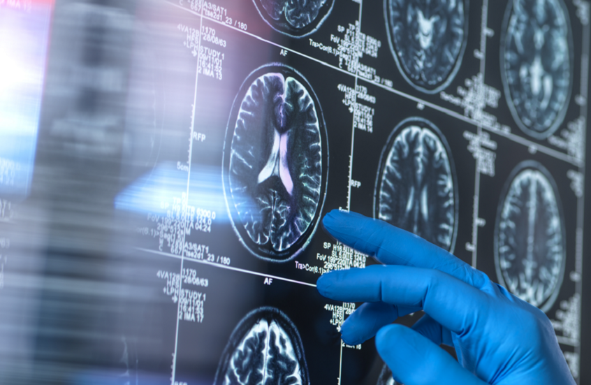 قبل فقدان الذاكرة.. إشارات خفية تكشف الإصابة بالخرف