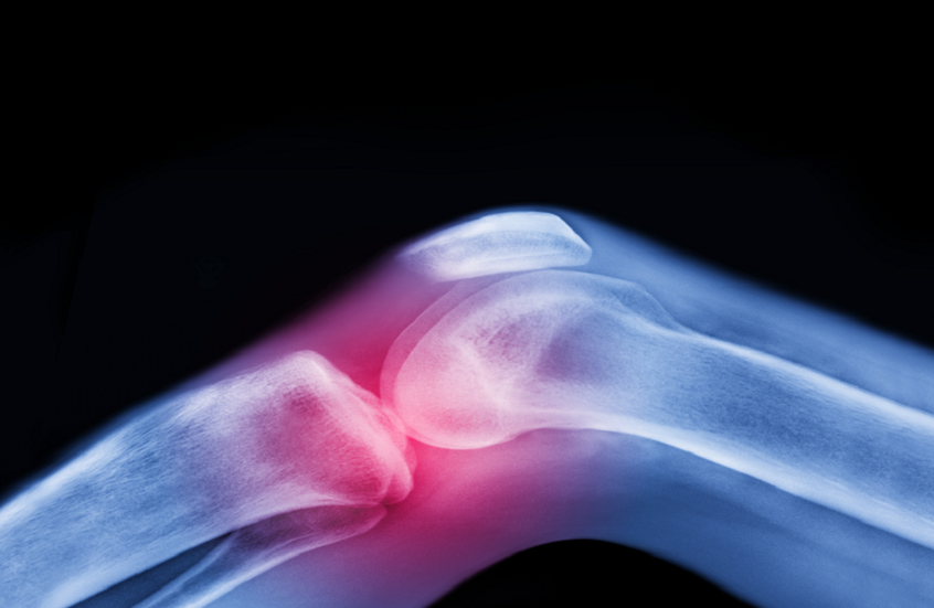 ابتكار ثوري.. ركبة بشرية حية قد تنهي معاناة آلام المفاصل