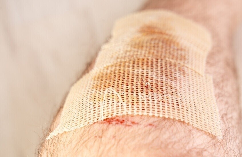 علماء يطورون تقنية جديدة تُسرّع التئام الجروح عبر تنشيط خلايا الجلد