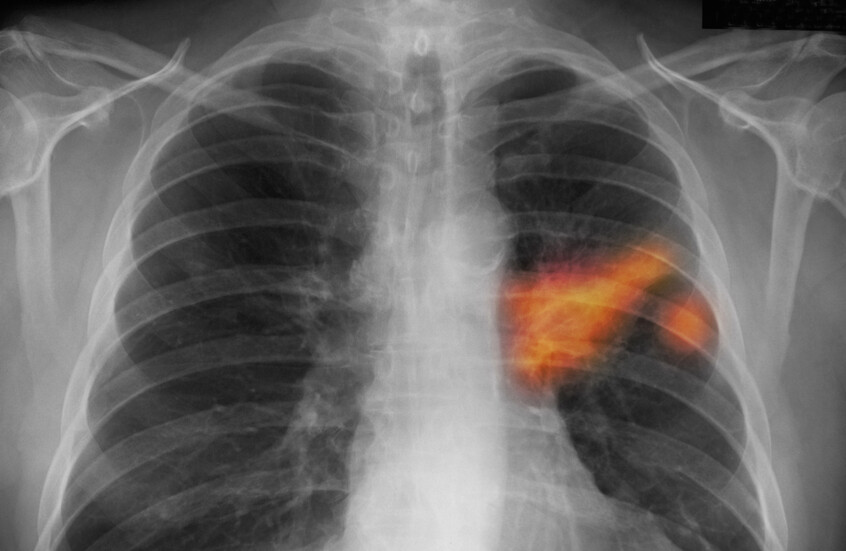 العلماء يحددون آلية تربط "كوفيد-19" بسرطان الرئة